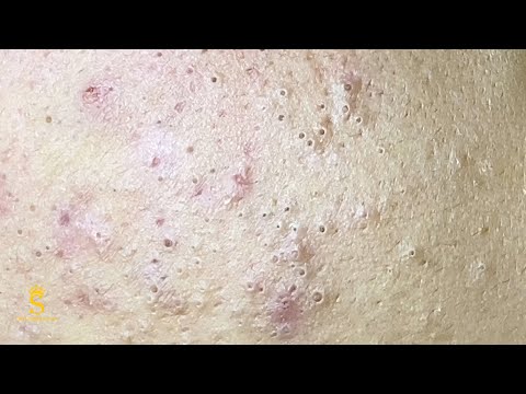 #1 How To Remove A Blackhead | Cách Loại Bỏ Mụn Đầu Đen Nhanh Chóng – SacDepSpa#230 Mới Nhất