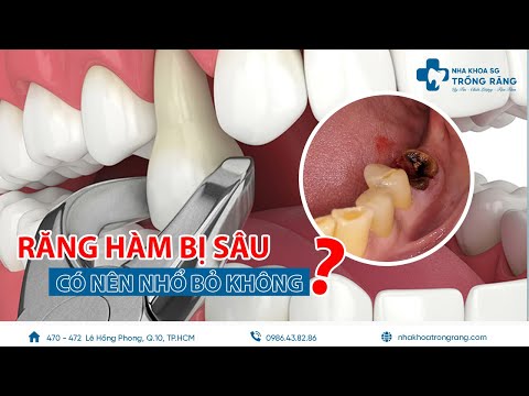 #1 Răng hàm bị sâu có nên nhổ bỏ không? | Cách chữa sâu răng hàm Mới Nhất