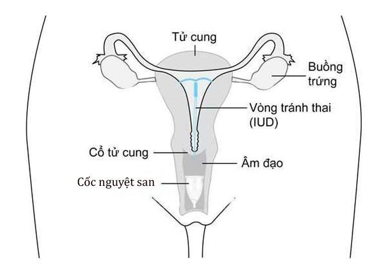 Cốc nguyệt san có làm rộng âm đạo không?